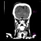Pneumocephalus: CT - Computed tomography